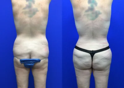 Brazilian Butt Lift before and after photos by Cabbabe Plastic Surgery in Saint Louis, MO