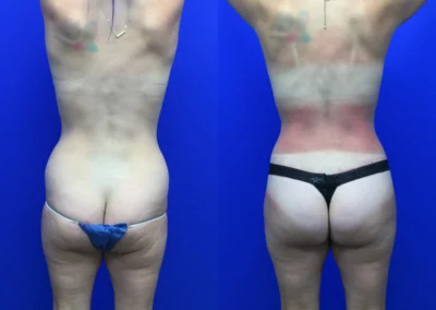 Brazilian Butt Lift before and after photos by Cabbabe Plastic Surgery in Saint Louis, MO