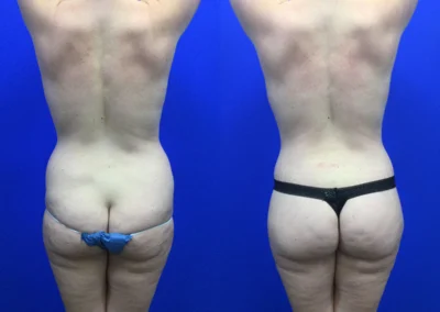 Brazilian Butt Lift before and after photos by Cabbabe Plastic Surgery in Saint Louis, MO