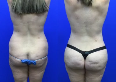 Brazilian Butt Lift before and after photos by Cabbabe Plastic Surgery in Saint Louis, MO