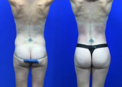 Brazilian Butt Lift before and after photos by Cabbabe Plastic Surgery in Saint Louis, MO