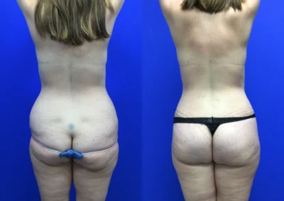 Brazilian Butt Lift before and after photos by Cabbabe Plastic Surgery in Saint Louis, MO