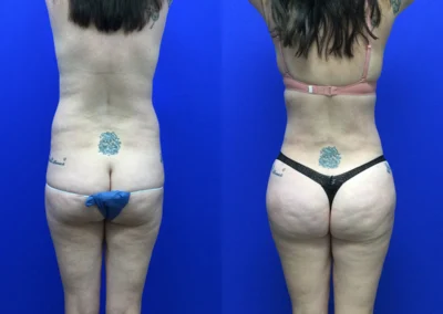 Brazilian Butt Lift before and after photos by Cabbabe Plastic Surgery in Saint Louis, MO