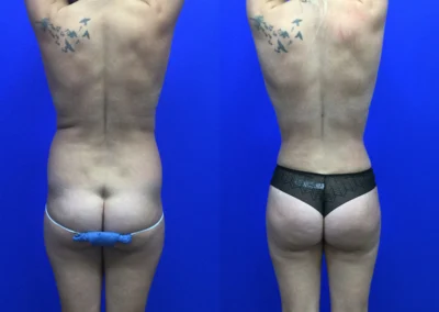 Brazilian Butt Lift before and after photos by Cabbabe Plastic Surgery in Saint Louis, MO