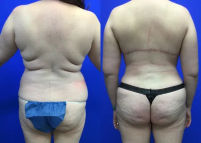Brazilian Butt Lift before and after photos by Cabbabe Plastic Surgery in Saint Louis, MO