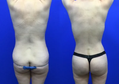 Brazilian Butt Lift before and after photos by Cabbabe Plastic Surgery in Saint Louis, MO