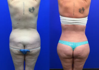 Brazilian Butt Lift before and after photos by Cabbabe Plastic Surgery in Saint Louis, MO