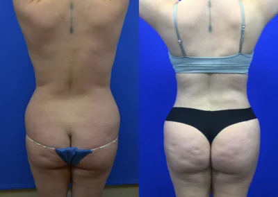 Brazilian Butt Lift before and after photos by Cabbabe Plastic Surgery in Saint Louis, MO