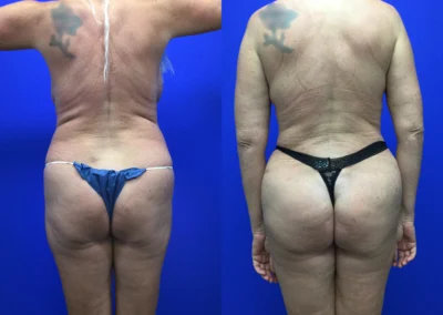 Brazilian Butt Lift before and after photos by Cabbabe Plastic Surgery in Saint Louis, MO