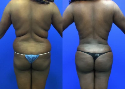 Brazilian Butt Lift before and after photos by Cabbabe Plastic Surgery in Saint Louis, MO