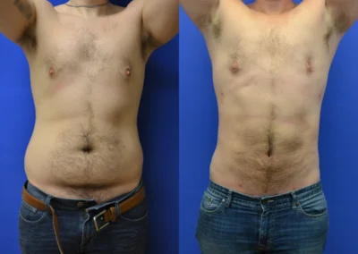 Liposuction before and after photos by Cabbabe Plastic Surgery in Saint Louis, MO