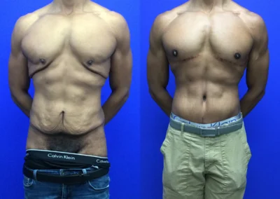 Chest Lift before and after photos by Cabbabe Plastic Surgery in Saint Louis, MO