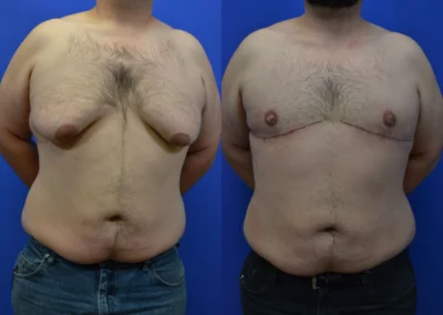 Chest Lift before and after photos by Cabbabe Plastic Surgery in Saint Louis, MO