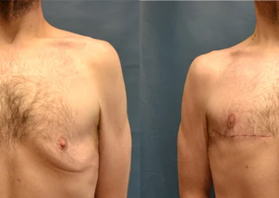 Chest Lift before and after photos by Cabbabe Plastic Surgery in Saint Louis, MO