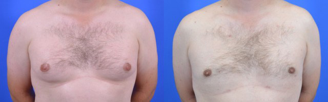 Gynecomastia before and after photos by Cabbabe Plastic Surgery in Saint Louis, MO