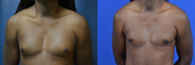 Gynecomastia before and after photos by Cabbabe Plastic Surgery in Saint Louis, MO