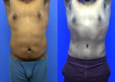 Tummy Tuck (men) before and after photos by Cabbabe Plastic Surgery in Saint Louis, MO