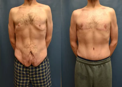 Tummy Tuck (men) before and after photos by Cabbabe Plastic Surgery in Saint Louis, MO
