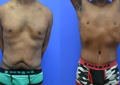 Tummy Tuck (men) before and after photos by Cabbabe Plastic Surgery in Saint Louis, MO