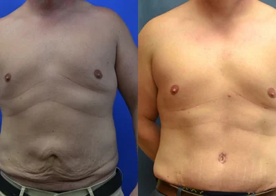 Tummy Tuck (men) before and after photos by Cabbabe Plastic Surgery in Saint Louis, MO
