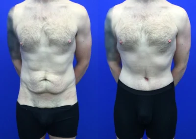 Lower Body Lift (men) before and after photos by Cabbabe Plastic Surgery in Saint Louis, MO