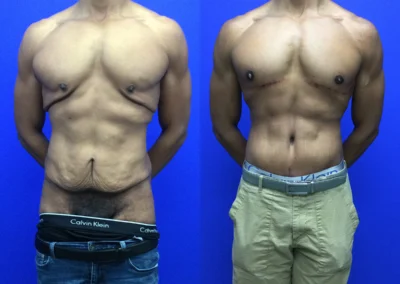 Lower Body Lift (men) before and after photos by Cabbabe Plastic Surgery in Saint Louis, MO