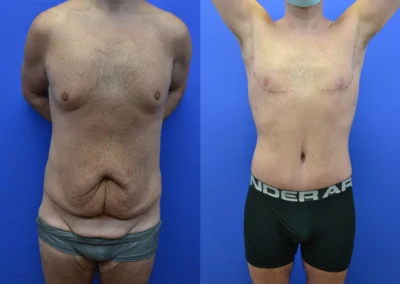 Lower Body Lift (men) before and after photos by Cabbabe Plastic Surgery in Saint Louis, MO