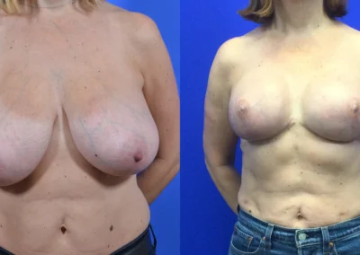Implant Reconstruction before and after photos by Cabbabe Plastic Surgery in Saint Louis, MO