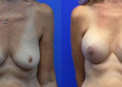 Implant Reconstruction before and after photos by Cabbabe Plastic Surgery in Saint Louis, MO