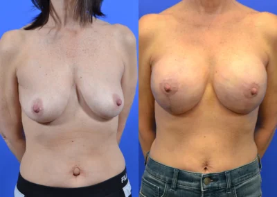 Implant Reconstruction before and after photos by Cabbabe Plastic Surgery in Saint Louis, MO