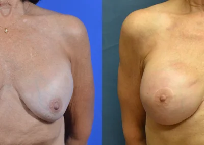 Implant Reconstruction before and after photos by Cabbabe Plastic Surgery in Saint Louis, MO