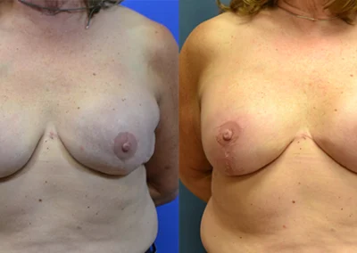 Implant Reconstruction before and after photos by Cabbabe Plastic Surgery in Saint Louis, MO