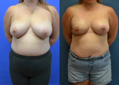 Implant Reconstruction before and after photos by Cabbabe Plastic Surgery in Saint Louis, MO