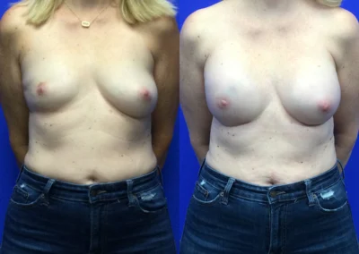 Implant Reconstruction before and after photos by Cabbabe Plastic Surgery in Saint Louis, MO