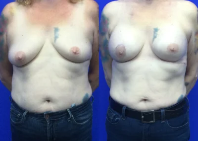 Implant Reconstruction before and after photos by Cabbabe Plastic Surgery in Saint Louis, MO