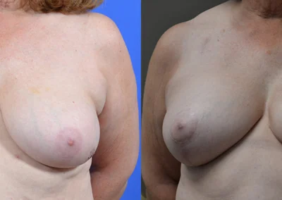 Latissimus Flap before and after photos by Cabbabe Plastic Surgery in Saint Louis, MO