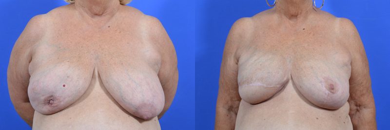 Latissimus Flap before and after photos by Cabbabe Plastic Surgery in Saint Louis, MO