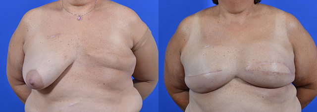 Latissimus Flap before and after photos by Cabbabe Plastic Surgery in Saint Louis, MO