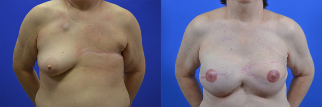 Latissimus Flap before and after photos by Cabbabe Plastic Surgery in Saint Louis, MO