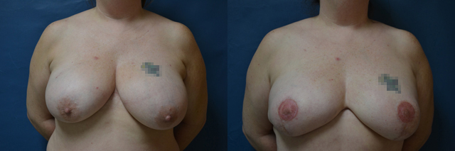 Latissimus Flap before and after photos by Cabbabe Plastic Surgery in Saint Louis, MO
