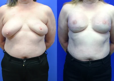 Latissimus Flap before and after photos by Cabbabe Plastic Surgery in Saint Louis, MO