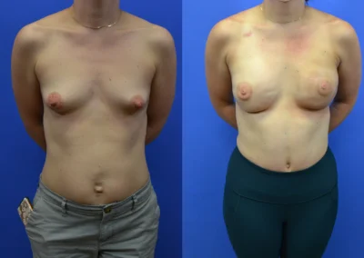 Latissimus Flap before and after photos by Cabbabe Plastic Surgery in Saint Louis, MO