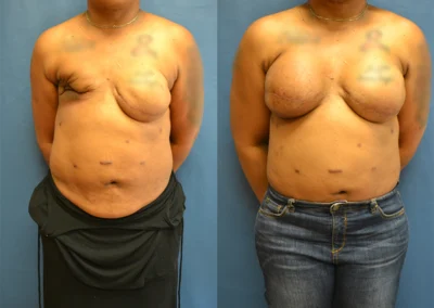 Latissimus Flap before and after photos by Cabbabe Plastic Surgery in Saint Louis, MO