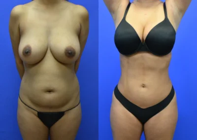 Liposuction before and after photos by Cabbabe Plastic Surgery in Saint Louis, MO