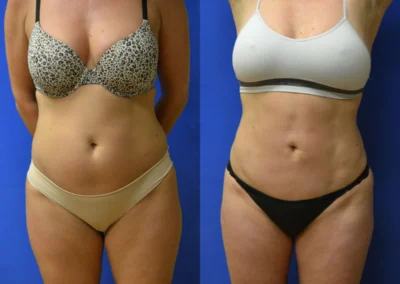 Liposuction before and after photos by Cabbabe Plastic Surgery in Saint Louis, MO
