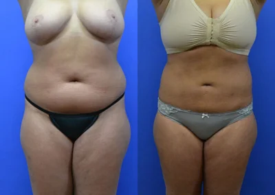 Liposuction before and after photos by Cabbabe Plastic Surgery in Saint Louis, MO