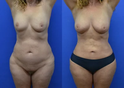 Liposuction before and after photos by Cabbabe Plastic Surgery in Saint Louis, MO