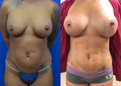 Liposuction before and after photos by Cabbabe Plastic Surgery in Saint Louis, MO
