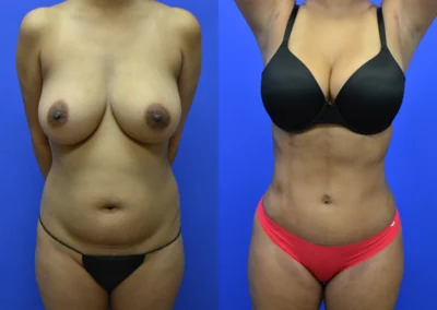 Liposuction before and after photos by Cabbabe Plastic Surgery in Saint Louis, MO