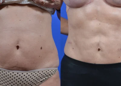 Liposuction before and after photos by Cabbabe Plastic Surgery in Saint Louis, MO
